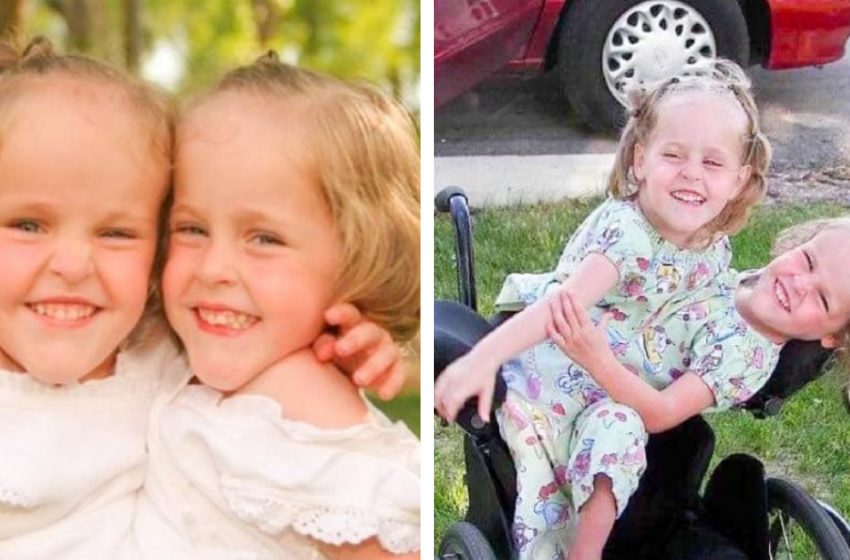  Diese siamesischen Zwillinge wurden im Alter von 4 Jahren getrennt und sind jetzt 18 Jahre alt. Wie leben sie jetzt?