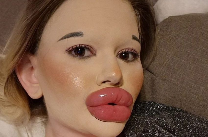 Eine 25 Jährige Frau Hat Mehr Als 27 Eingriffe Gehabt Jetzt Hat Sie Die Größten Lippen Der Welt 4256