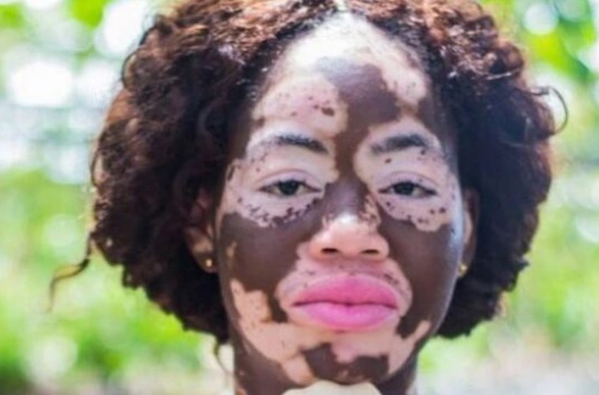  “Die Leute dachten, sie sei mit Säure übergossen worden”: Einzigartiges Mädchen mit Vitiligo, das die Welt erobert hat, teilte ihre Ganzkörperfotos!!