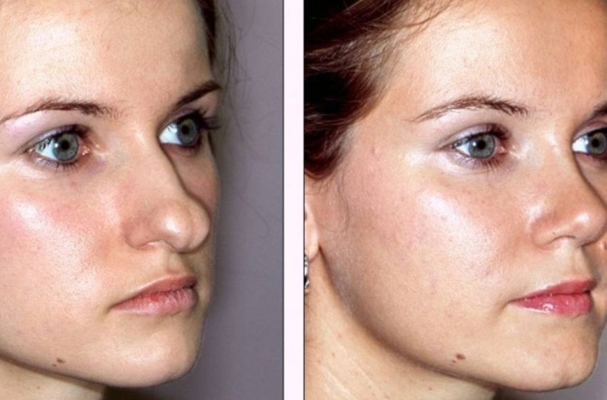  Die positive Seite der plastischen Chirurgie: Fotos von Mädchen, die plastische Chirurgie durchlaufen haben, um ihr Aussehen zu verbessern!