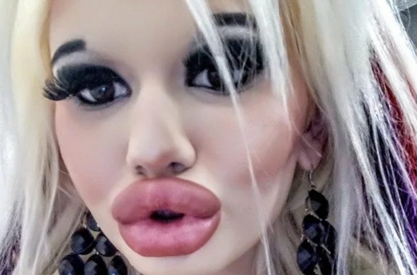  “Die Lippen nehmen den größten Teil ihres Gesichts ein”: Mädchen vergrößerte ihre Lippen, machte jedoch einen Fehler mit der Größe!