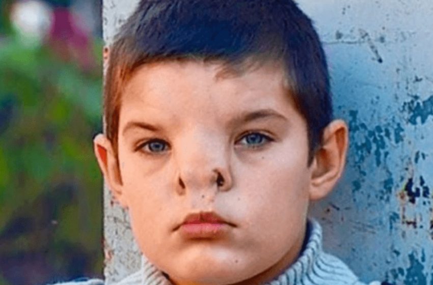  Ein Junge, der mit einer seltenen Nasenerkrankung geboren wurde, unterzog sich einer Operation: Wie sieht er jetzt aus?