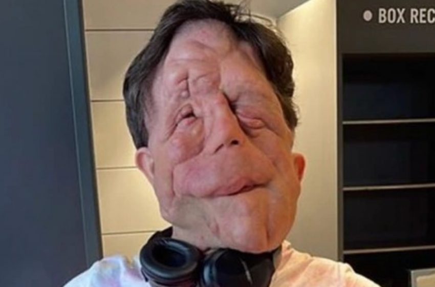  „Inspirierende Geschichte von Adam Pearson“: Wie der Mann mit „einzigartigem“ Aussehen seine Erkrankung überwand und ein Vorbild wurde!