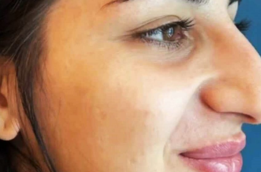  „Unrecognizable Transformation“: Wie die Rhinoplastik des Mädchens endlose Bewunderer anzog!