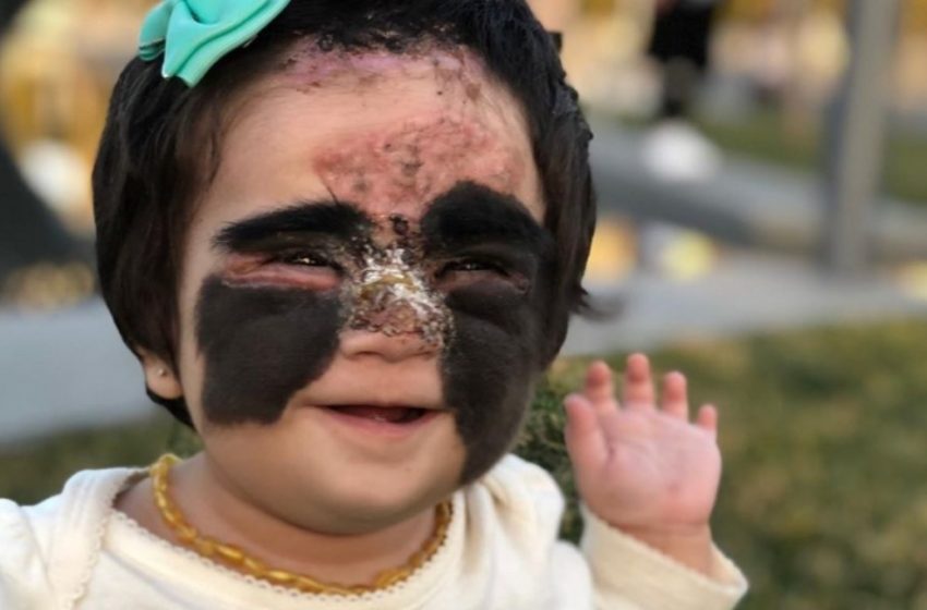  Einst wegen ihres “Batman”-Gesichts verspottet, beeindruckt das Mädchen jetzt mit einem prinzessinnenhaften Aussehen: “Unglaubliches Mädchen!”