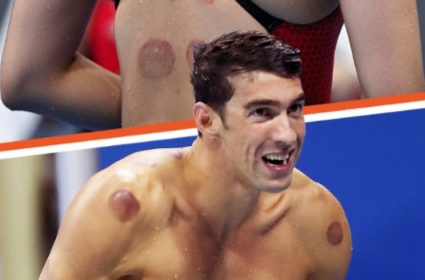  Fragst du dich über die runden blauen Flecken bei Olympischen Athleten? Hier ist der Grund!