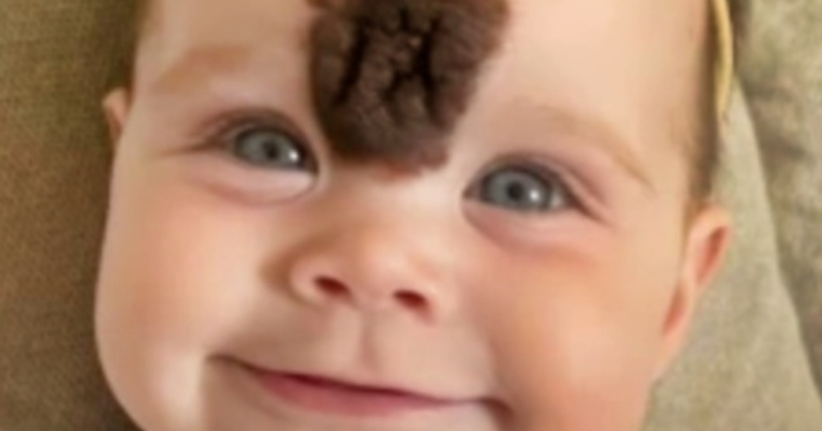 Eltern lassen das seltene Muttermal ihres Babys entfernen, um sie vor Grausamkeit zu schützen! – Sieh dir an, wie sie heute aussieht!
