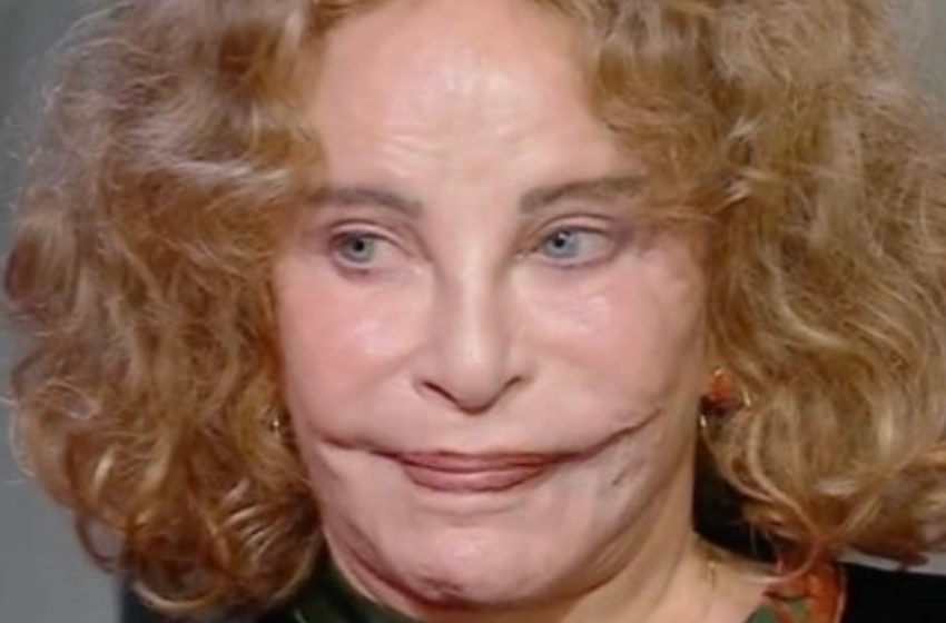 Sie wurde einst als die schönste Frau der Welt bezeichnet: Doch ein tragischer Unfall entstellte ihr Gesicht!