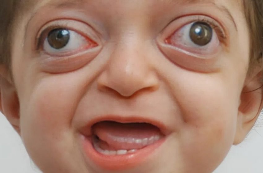  Ärzte verwandeln das ungewöhnliche Gesicht eines Jungen! Sehen Sie sein bemerkenswertes Aussehen nach all den Veränderungen!