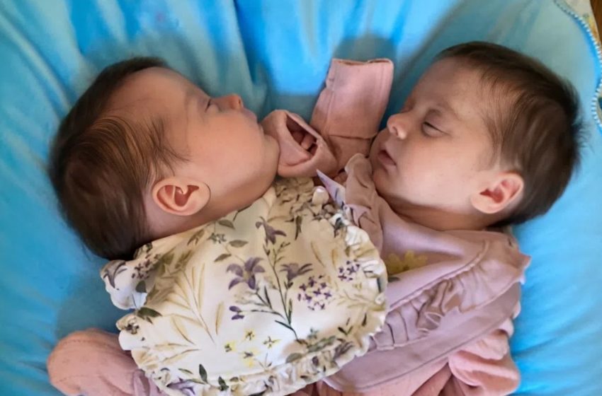  Von an der Brust zusammengewachsen zu gesunden Kindern: Getrennte Zwillinge 3 Jahre später – Sehen Sie ihre Fotos