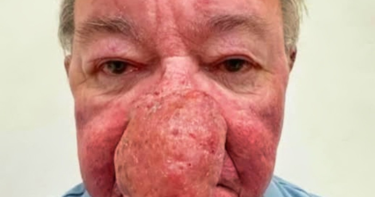 Mann mit extremem Nasenwachstum überrascht alle nach der Operation!: Seht die Fotos!