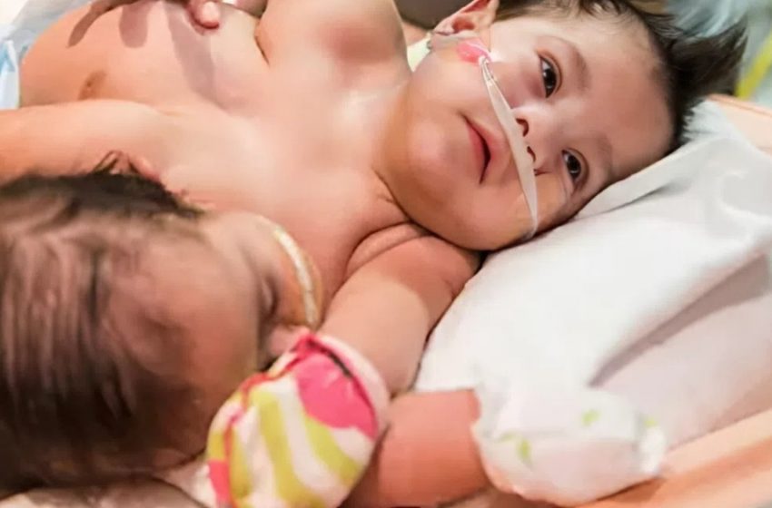  Die unglaubliche Geschichte siamesischer Zwillinge, die alle Widrigkeiten überwanden!: Wie sehen sie heute aus?